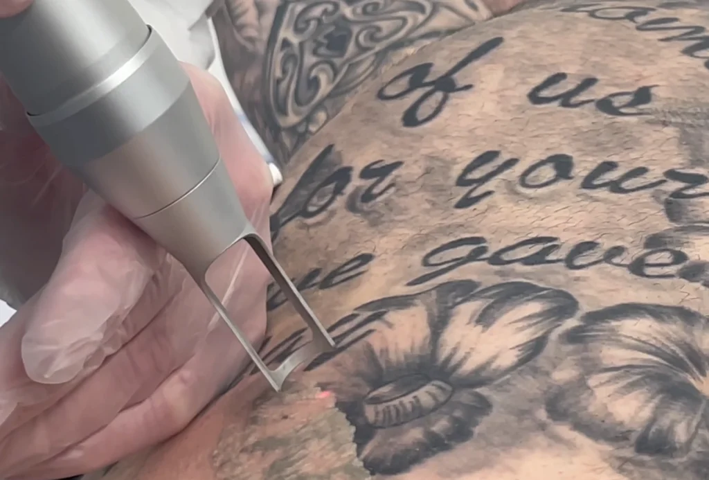 Can Laser Tattoo Removal Fade a Tattoo for a Cover-Up