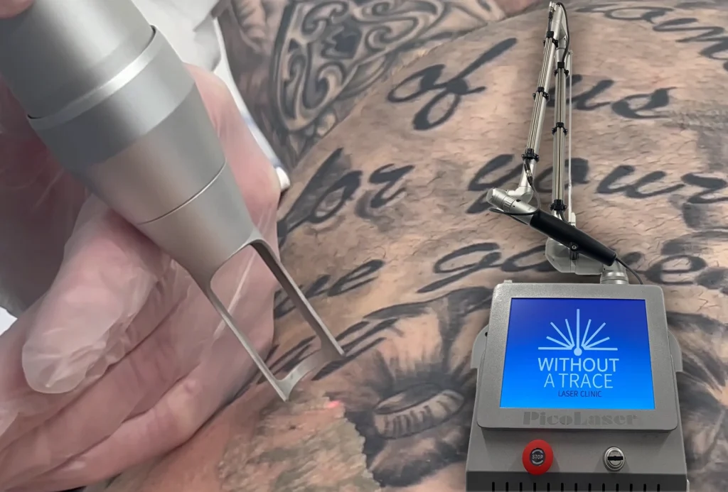 Introducing the Advanced Pico Laser for Tattoo Removal