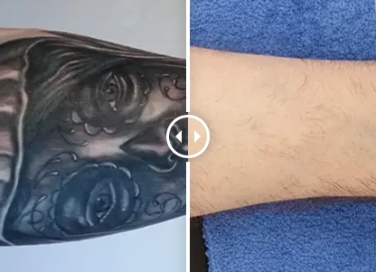 Before and after pics of Laser tattoo removals