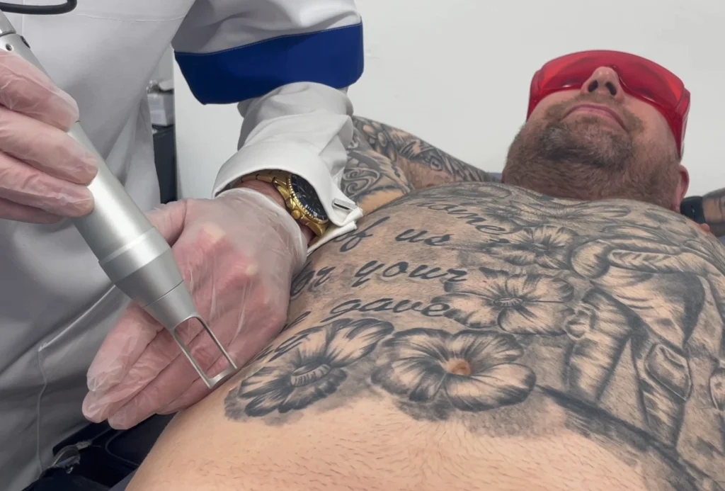 How Effective are Numbing Creams for Pico Laser Tattoo Removal?