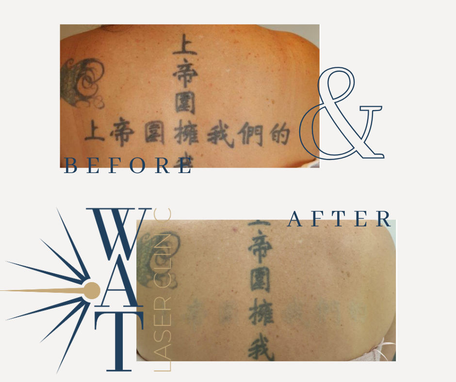 Laser Tattoo Removal Expectations